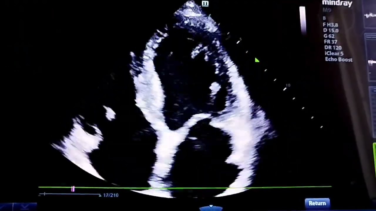 Inferior STEMI, Ischemic Dilated Cardiomyopathy 