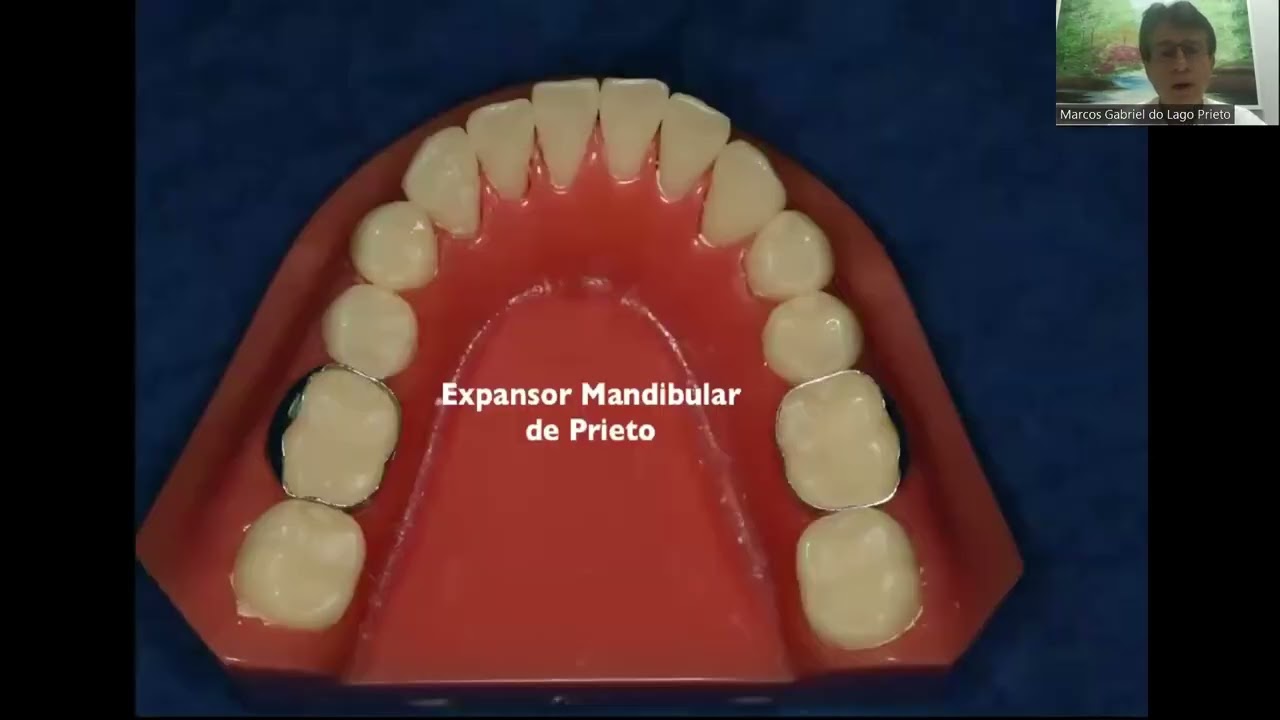 CORRECCIÓN DEL APIÑAMIENTO INFERIOR - Dr. MARCOS PRIETO