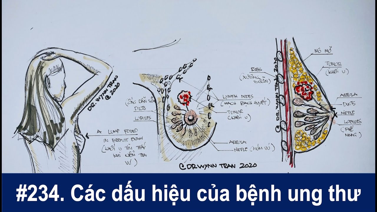 #234. Ung thư có những dấu hiệu nào và các loại BS chữa trị ung thư