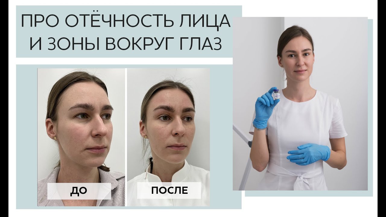 Про отечность лица и области вокруг глаз. Результаты ДО и ПОСЛЕ процедуры.