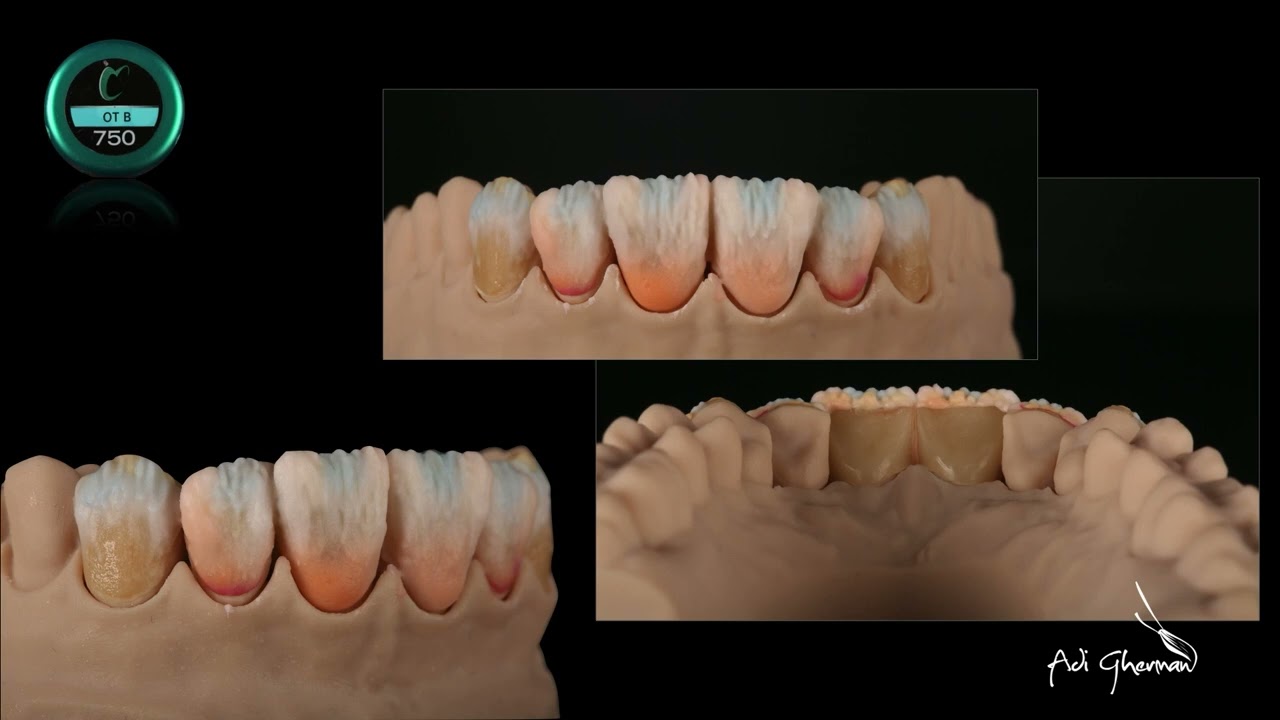 Step-by-Step Case - HeraCeram Zirkonia 750 on Amber Press (Hass) by Adi Gherman