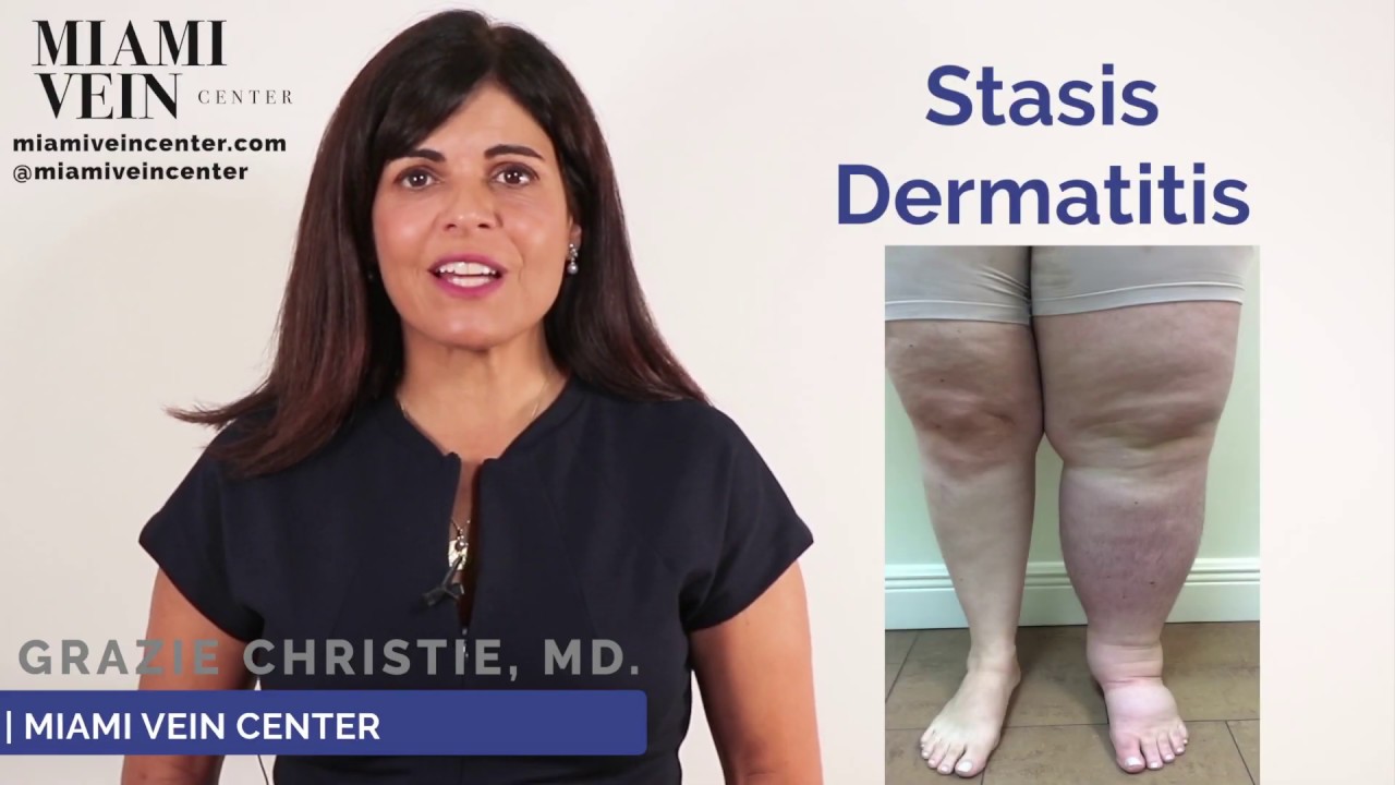 About Stasis Dermatitis Leg Discoloration