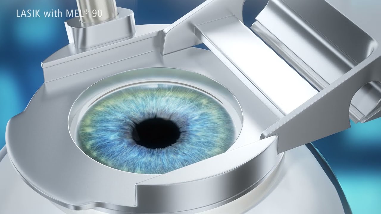 Microkeratome LASIK with MEL 90