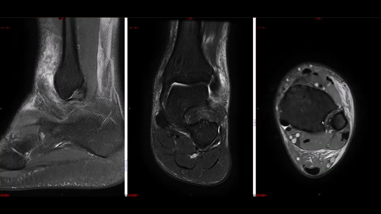Tornozelo - Lesão ligamentar lateral, pct 22 anos com entorse prévio