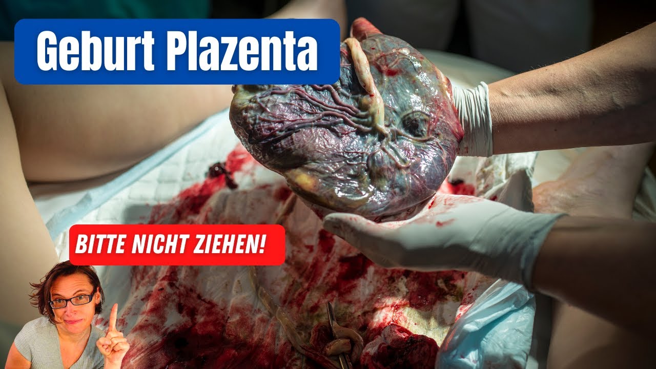 Geburt der Plazenta - warum das Ziehen an der Nabelnschnur vermieden werden sollte.