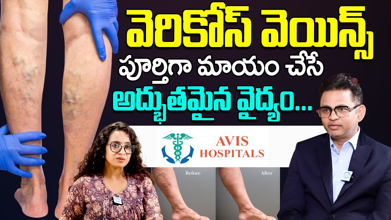 వెరికోస్ వెయిన్స్ ని పూర్తిగా మాయం చేసే అద్భుతమైన వైద్యం... || Varicose Veins Advance Treatment