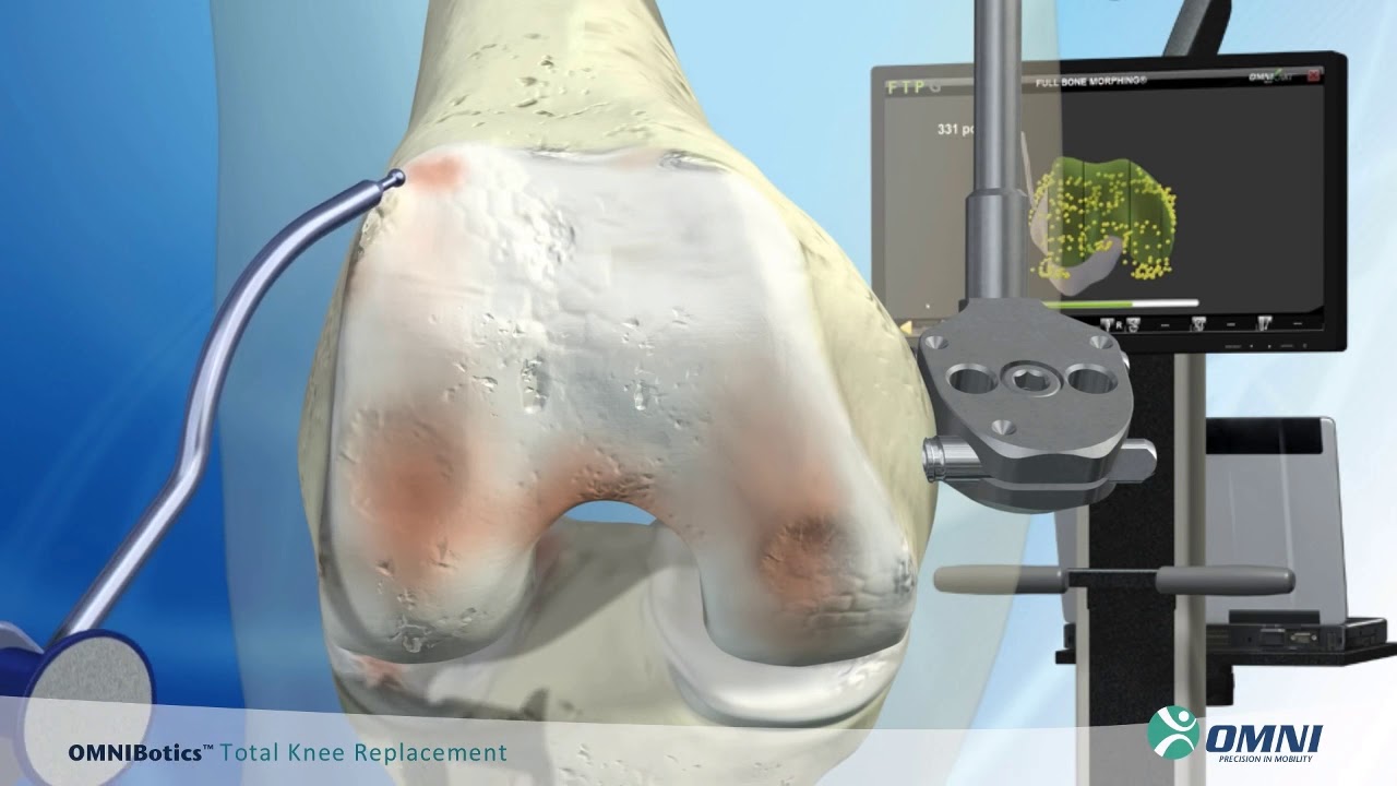 OMNIBotics Robotic Assisted TKR