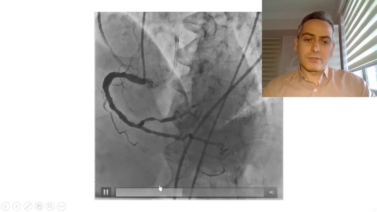 Koroner işlemler sırasında gelişen Aort Diseksiyonu Yönetimi Nasıl Olmalı ?