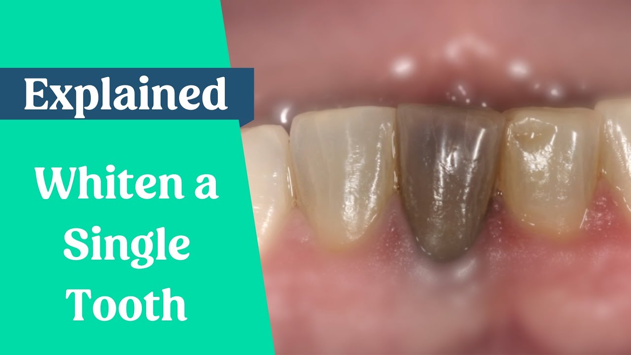 How to whiten a single dark tooth