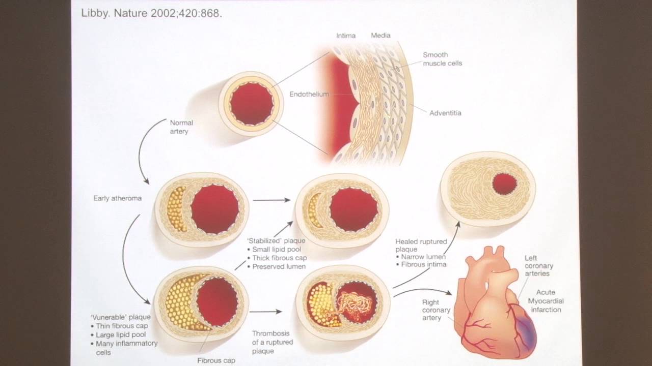 Heart Disease Prevention: What You Need to Know