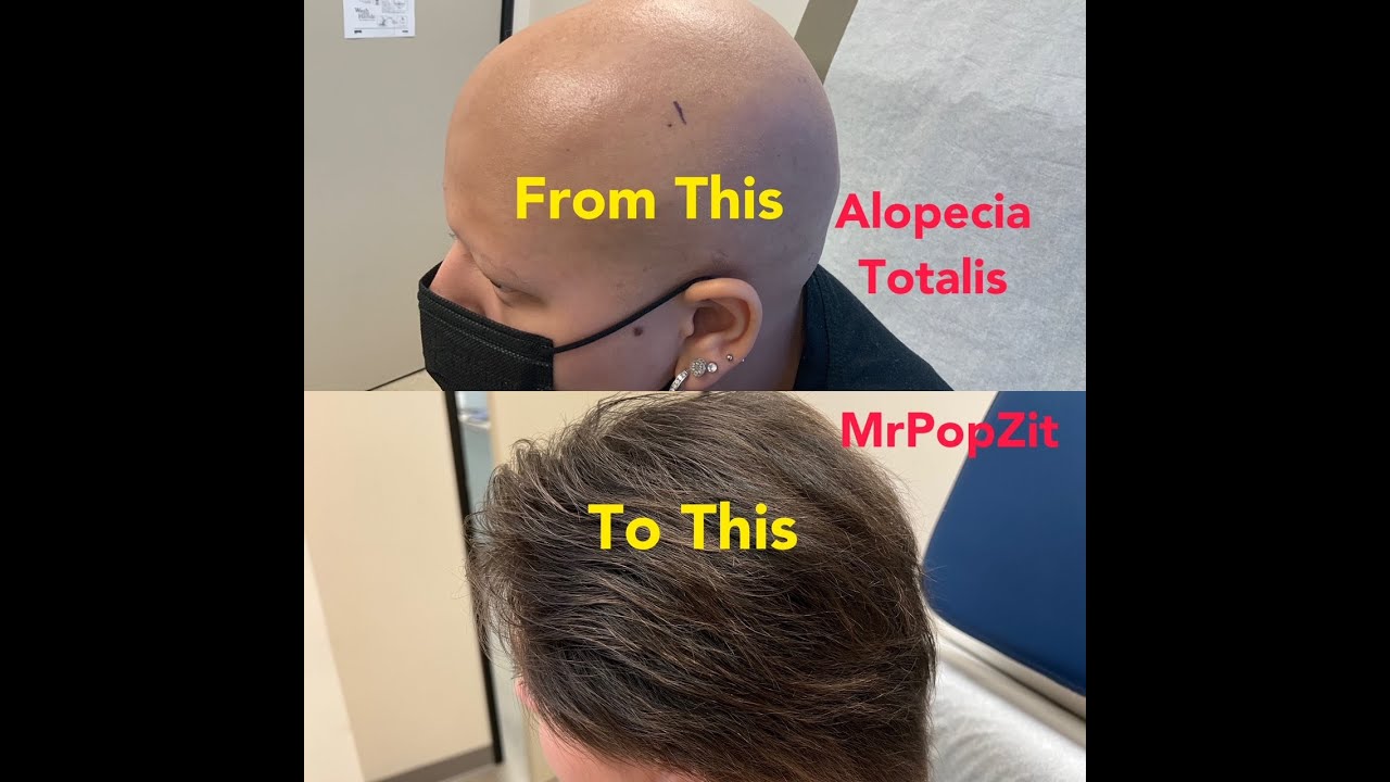 ALOPECIA TOTALIS 10 Month follow up. Patient was so happy she couldn’t stop smiling!
