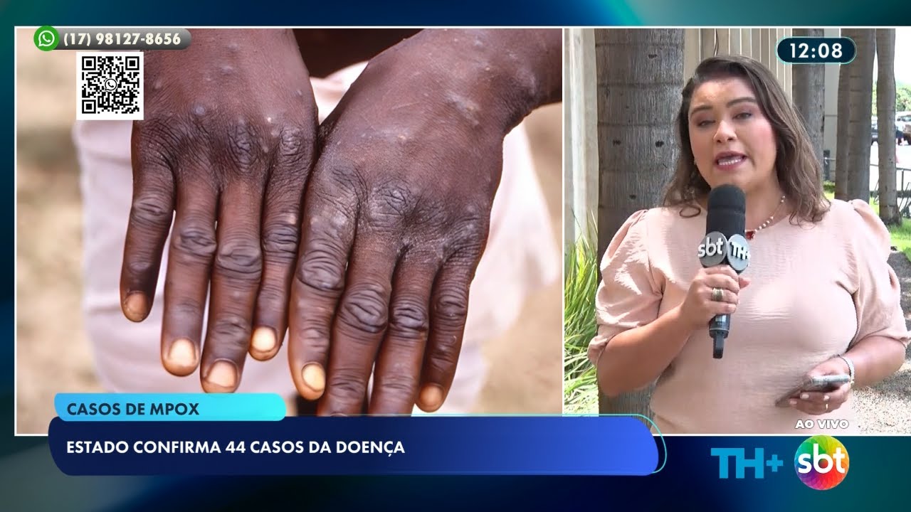 Estado de São Paulo registra 44 casos confirmados de mpox neste ano