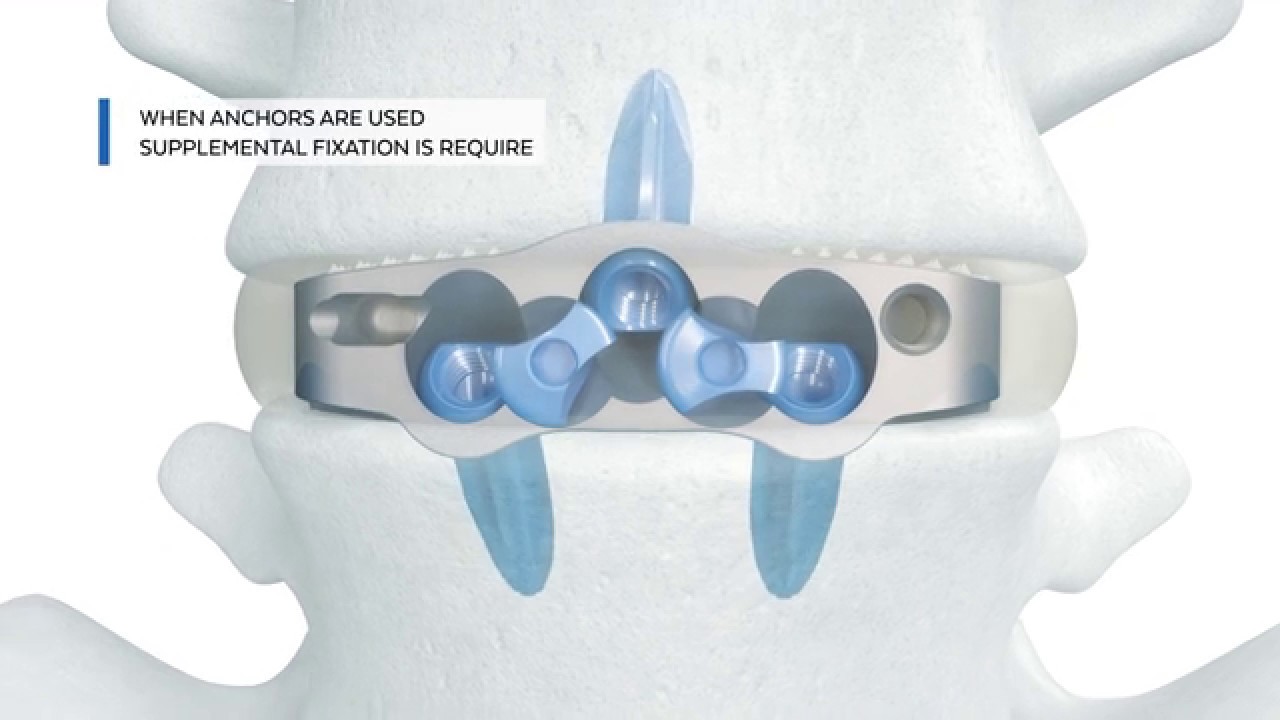 INDEPENDENCE MIS™ Spacer