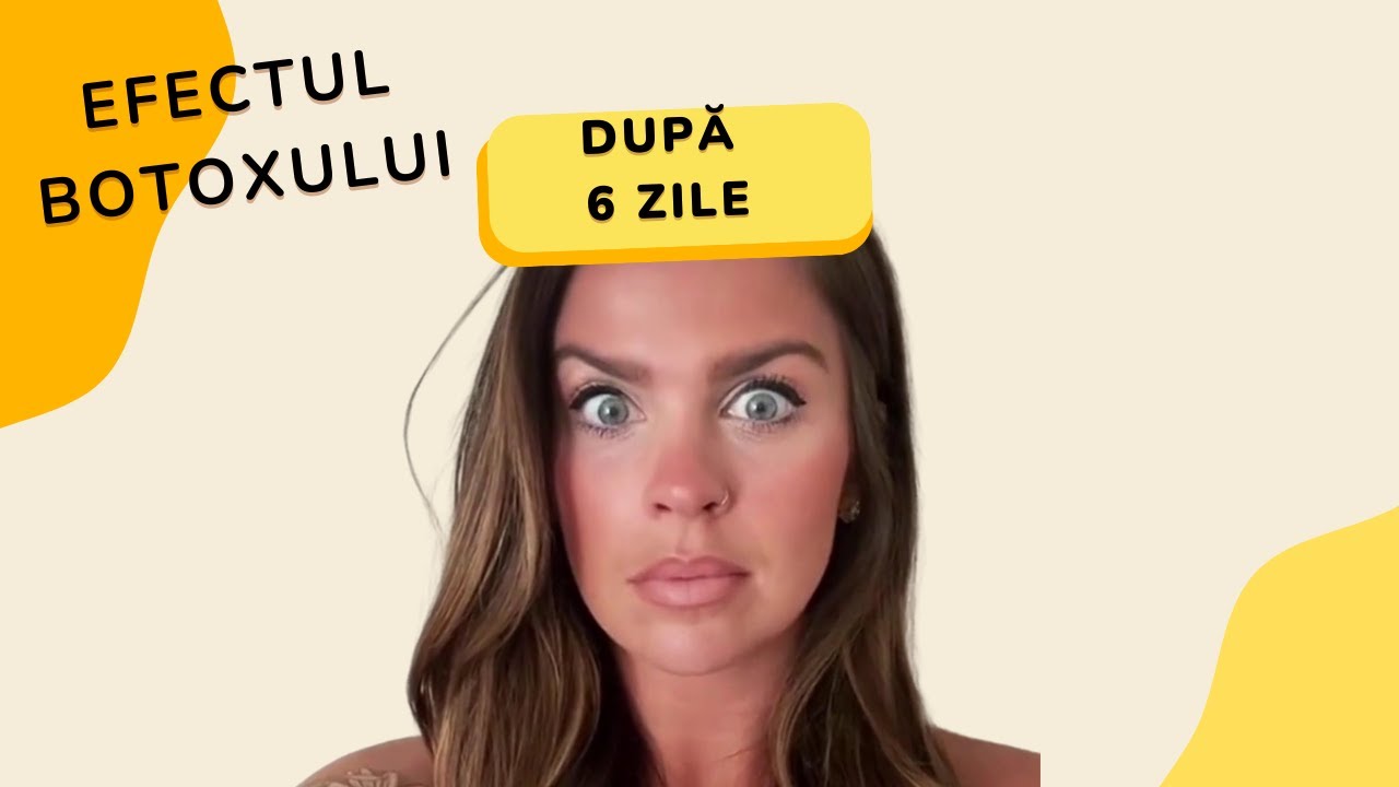 Efectul Botoxului după 6 zile