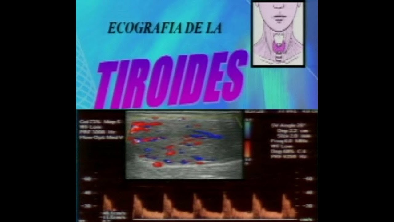 ECOGRAFIA DOPPLER DE TIROIDES