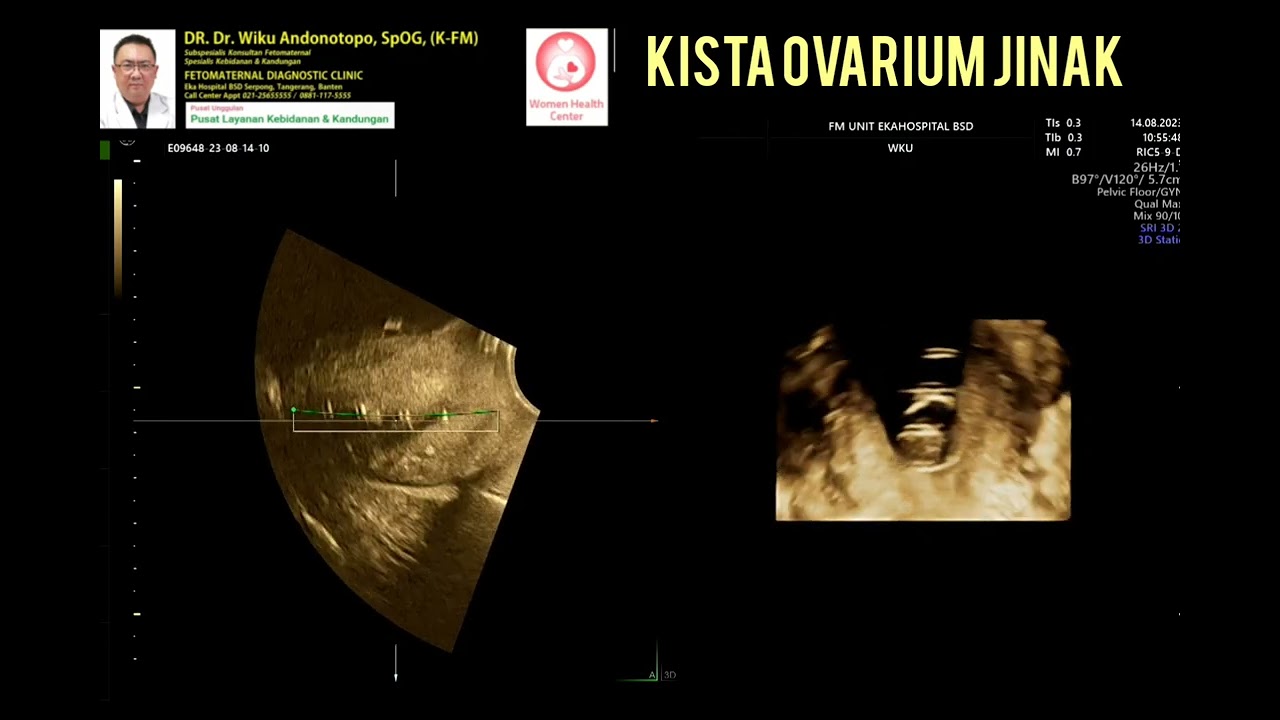Kista ovarium jinak dan IUD lipes Loop pada usia 70 thn menopause