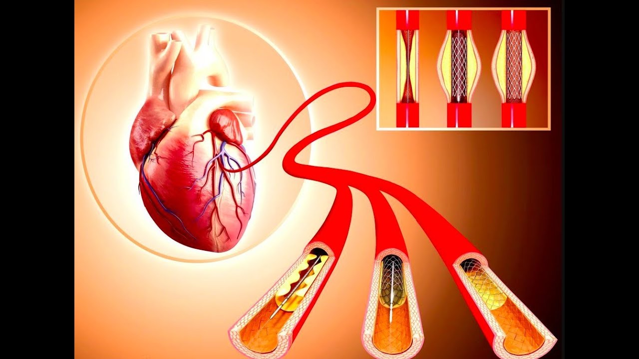Stent qoyulmuş ürək nə qədər yaşayır? - Kardiocərrah Qalib İmanov