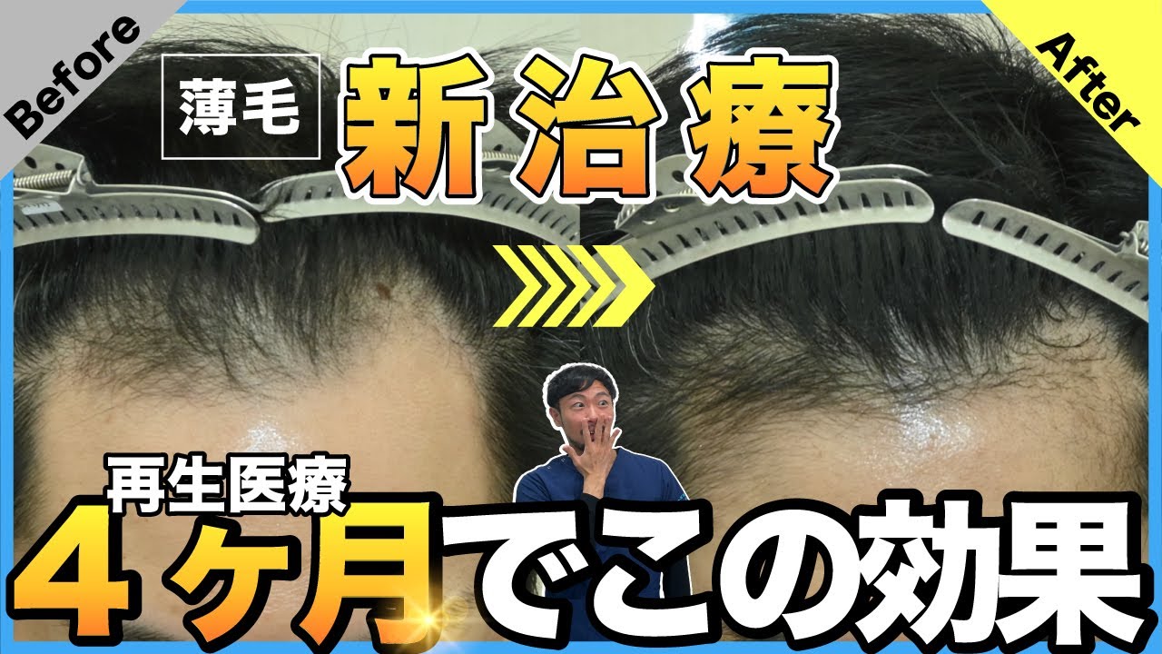 【薄毛の新治療】再生治療C-PRPメソセラピー短期間で効果実感！医師がメリット・デメリット忖度なしに語ります【湘南AGA仙台院 藤井医師】｜No.78