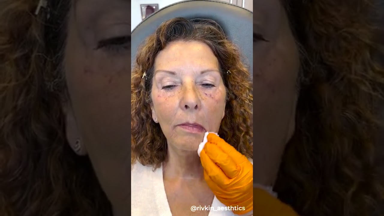 Как лечить марионеточные морщины | Westside Aesthetics