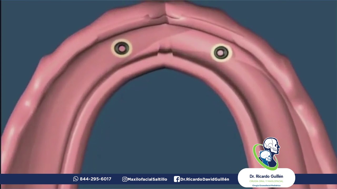 Implantes Dentales