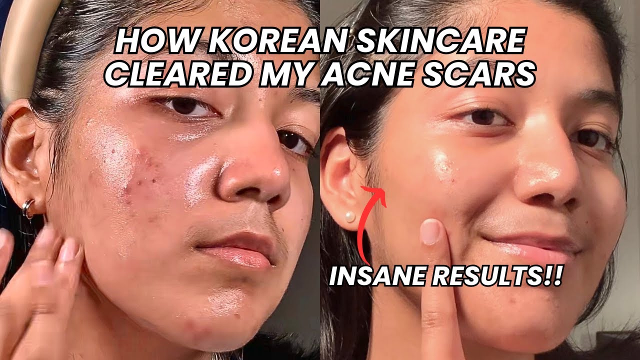 How I Cleared My Acne Scars with Korean Skincare | Affordable Korean skincare for Acne Prone Skin✨