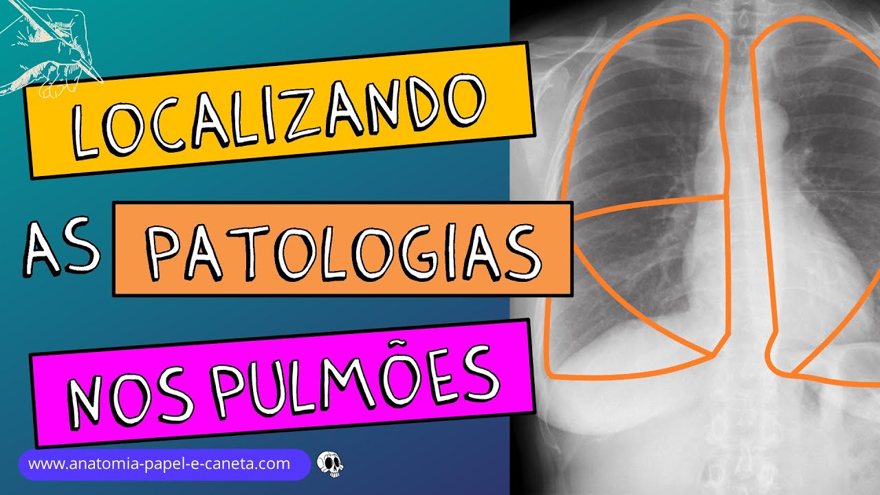 Pulmões no RX - Parte 2/2 - Como localizar as patologias no RX