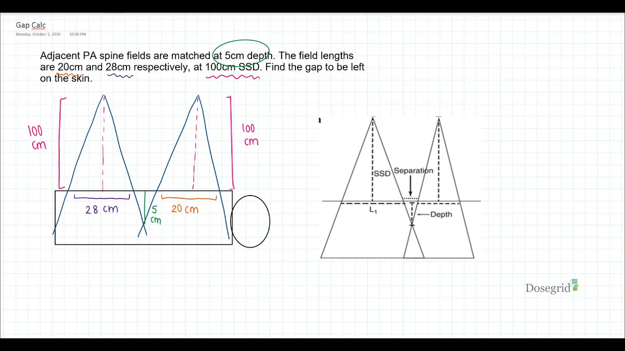 Gap Calculation (Craniospinal Irradiation)