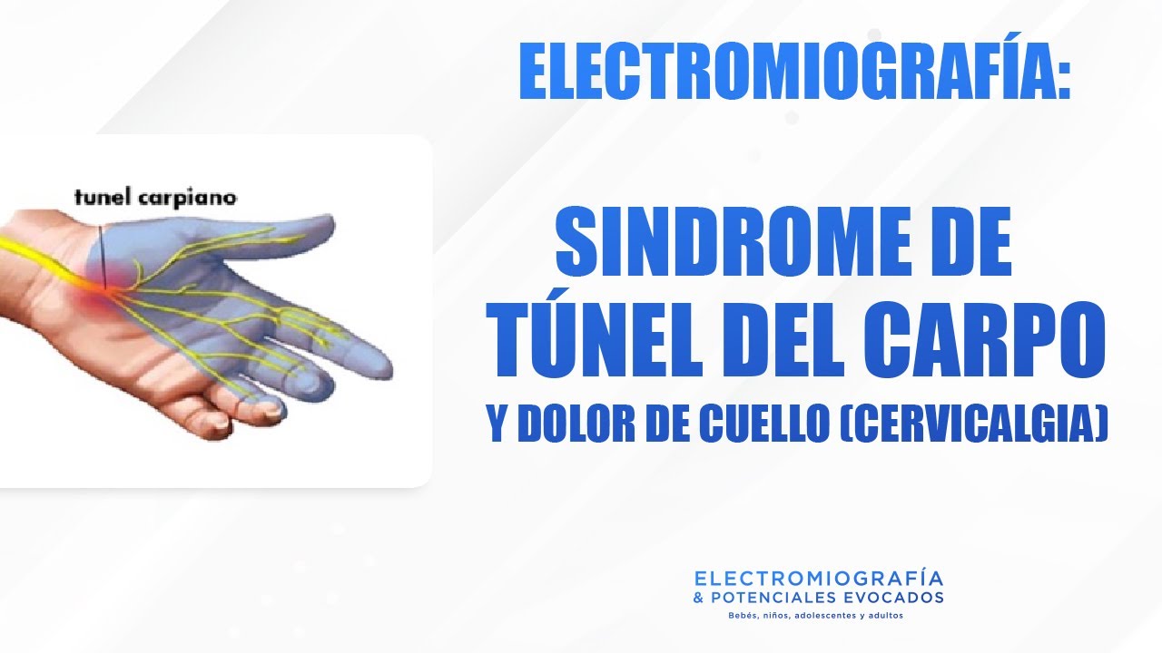 ELECTROMIOGRAFÍA: SINDROME DE TUNEL DEL CARPO Y DOLOR DE CUELLO (CERVICALGIA)