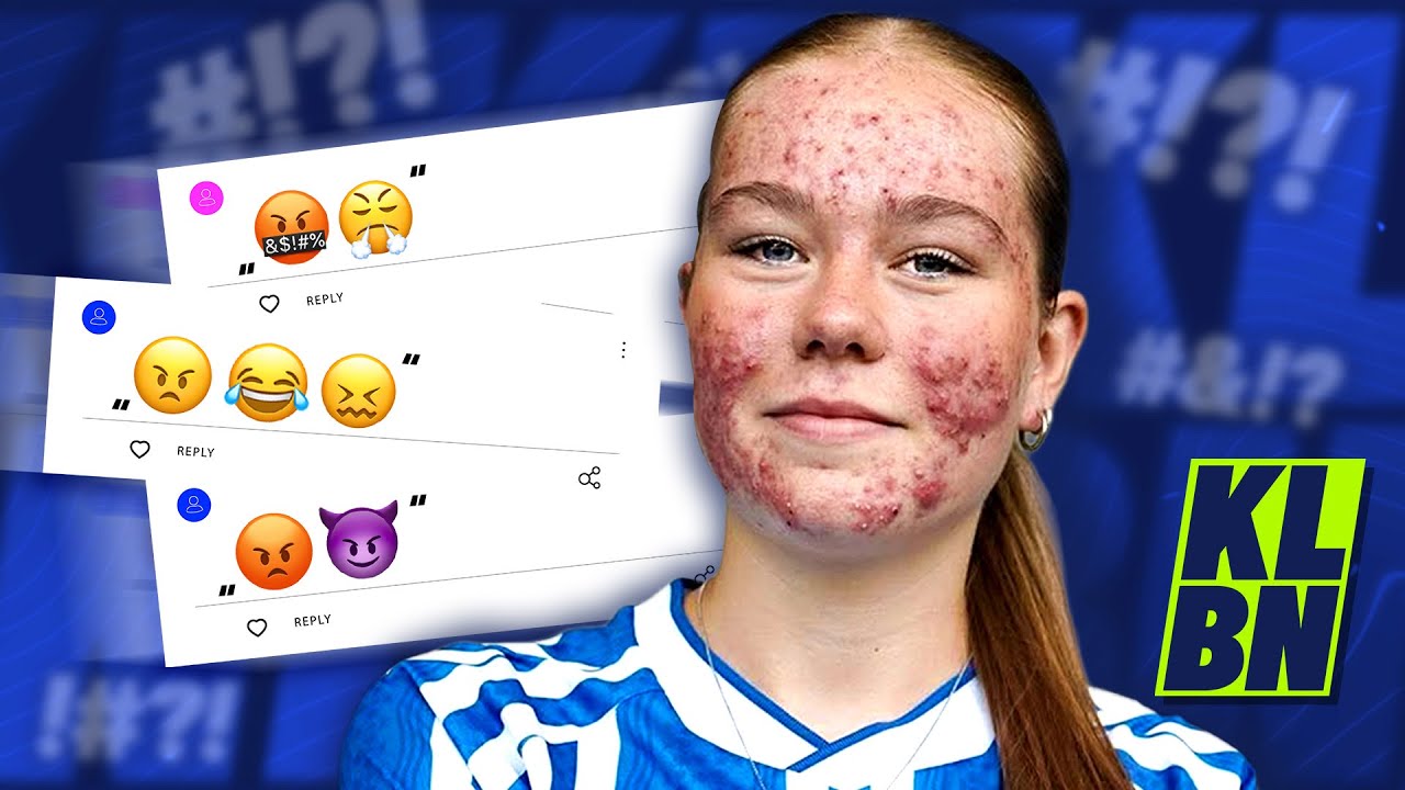 MOBBET med sin akne | KLUBBEN med Jonas