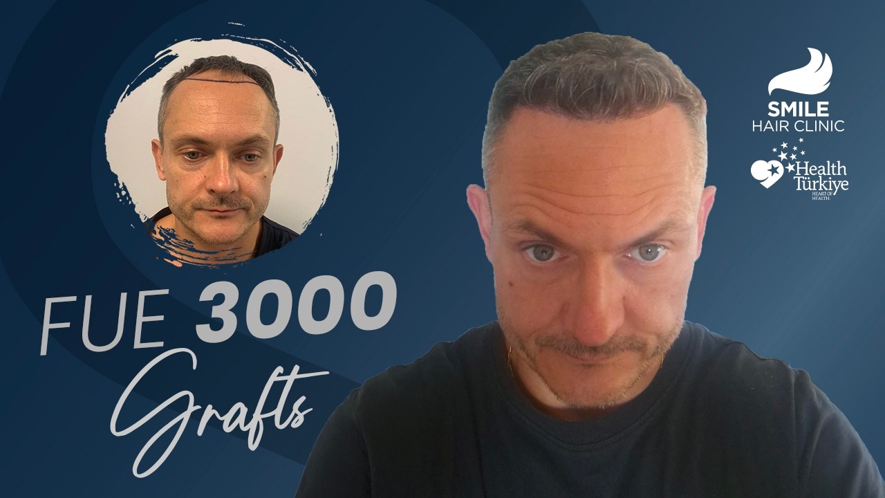 Hair Transplant Before and After | 3000 Grafts 12 Months Transformation