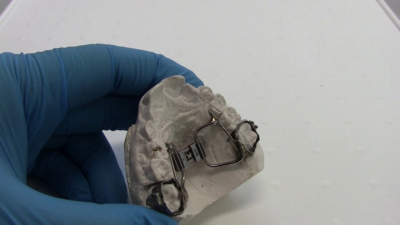 How to turn a RME ( Rapid Maxillary Expander for orthodontic treatment)