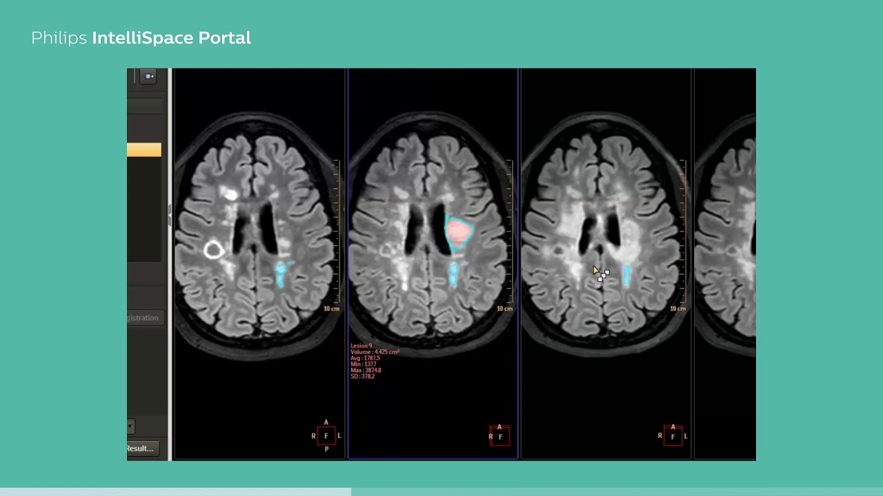 Philips IntelliSpace Portal  clinical application MR LoBI