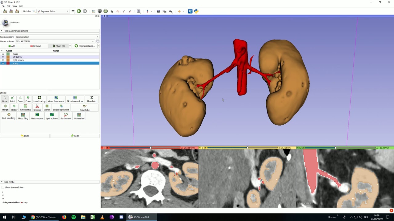 Organ segmentation 2: Kidneys, vessels, volumetry