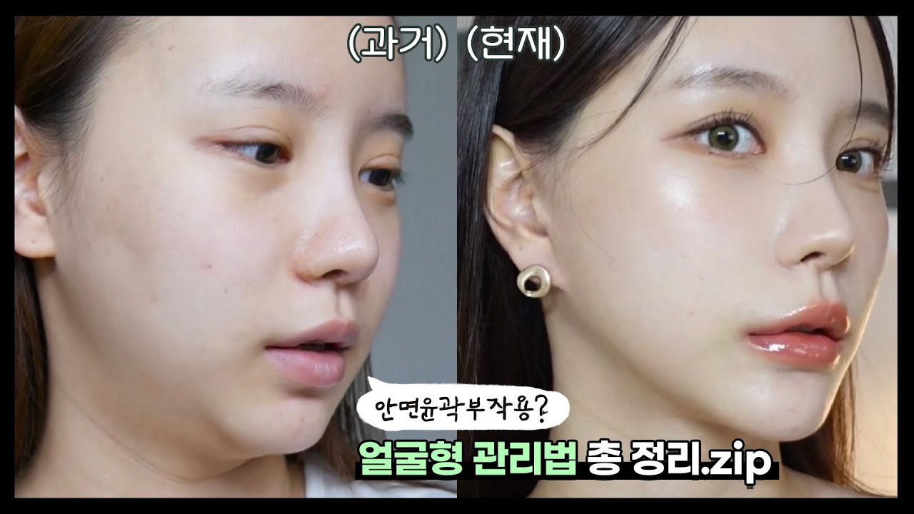 이중턱? 볼패임? 한번에 싹없애준 수술 드디어 처음으로 공개합니다 ...얼굴형 관리법 총정리!!👶✨(ENG/JPN)
