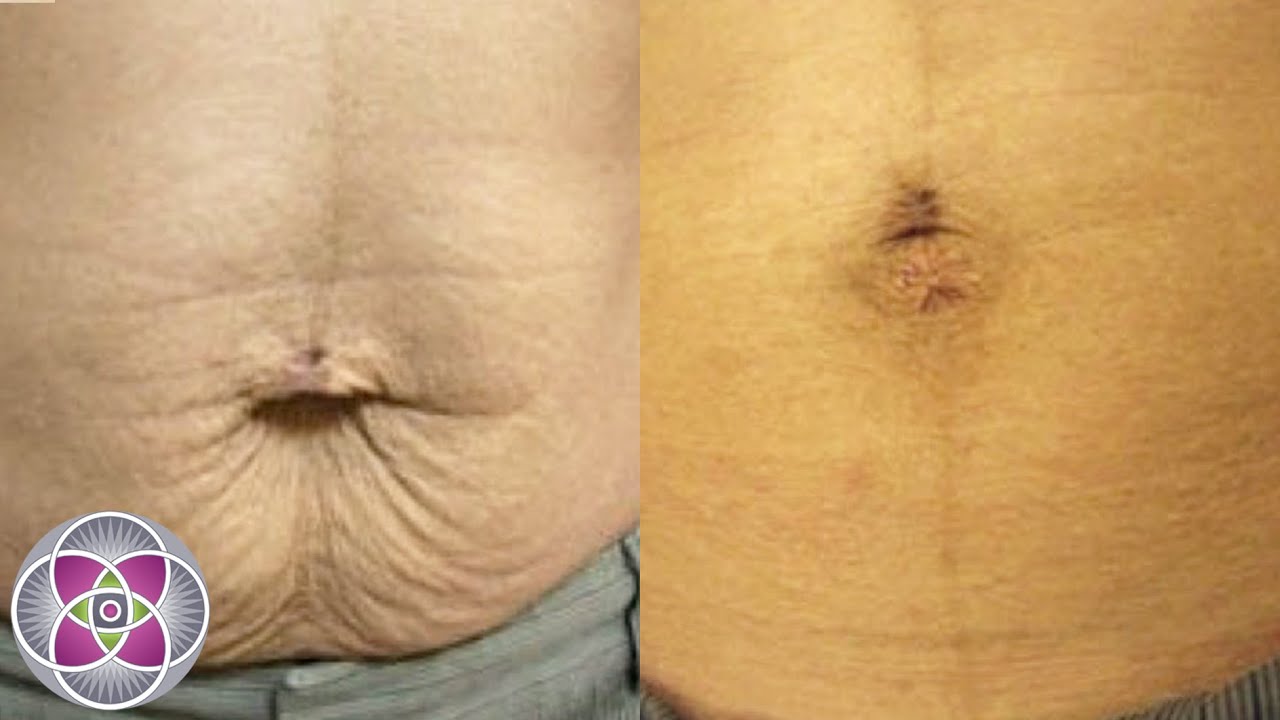 Laser Stretch Mark Removal & Skin Tightening