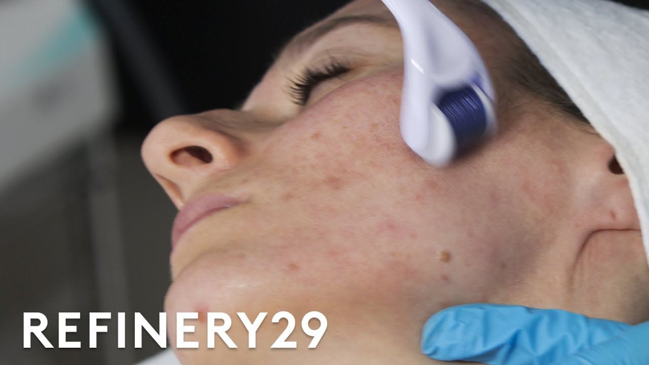 Why Microneedling Is The Best Acne Scar Treatment | Macro Beauty | Refinery29