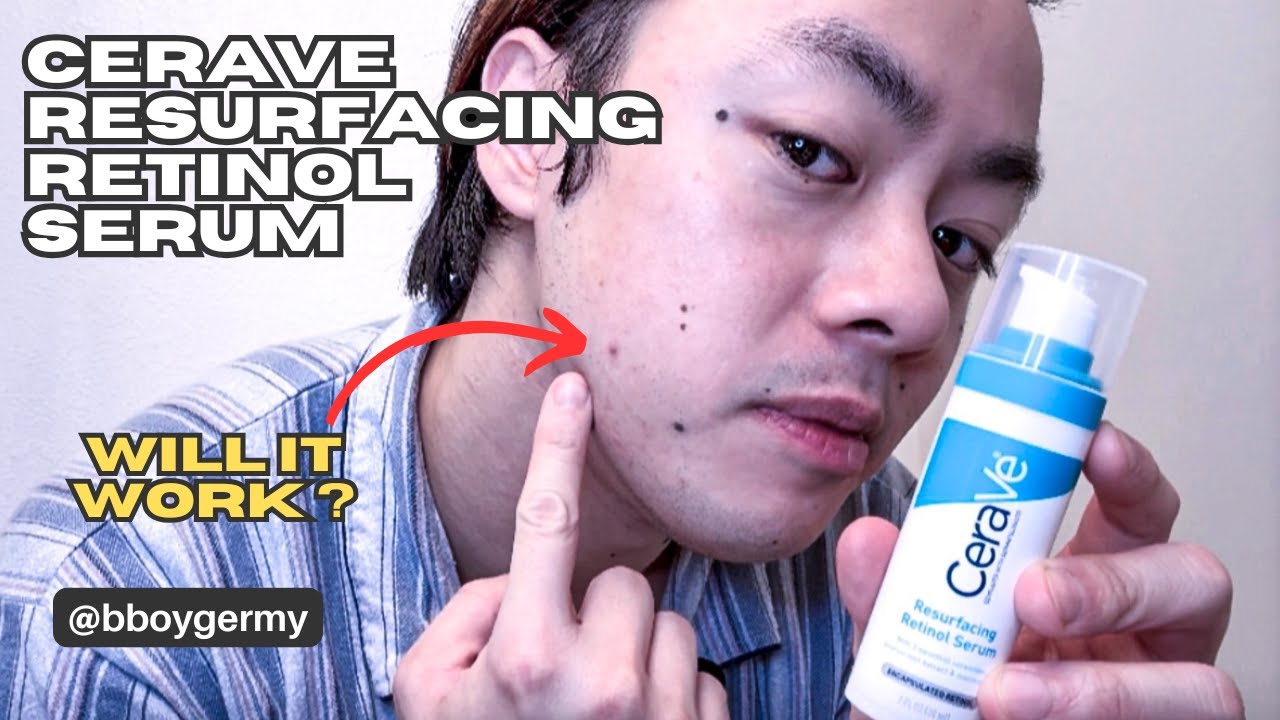 I Tried CeraVe Resurfacing Retinol Serum On My Acne Scar - One Month Results