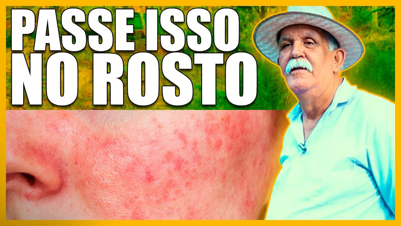 ROS&Aacute;CEAS *O QUE NA NATUREZA TEM O PODER DE MELHORAR E CURAR A PELE DO SEU ROSTO*
