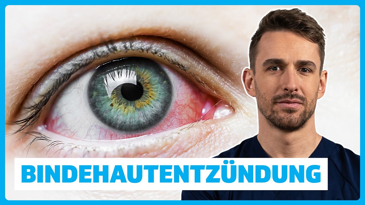 Bindehautentzündung (Konjunktivitis) verstehen: Ursachen, Symptome, Diagnose & Therapie | DocTommy