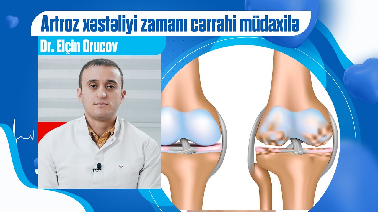 Artroz xəstəliyi zamanı cərrahi müdaxilə nə zaman qaçılmazdır?