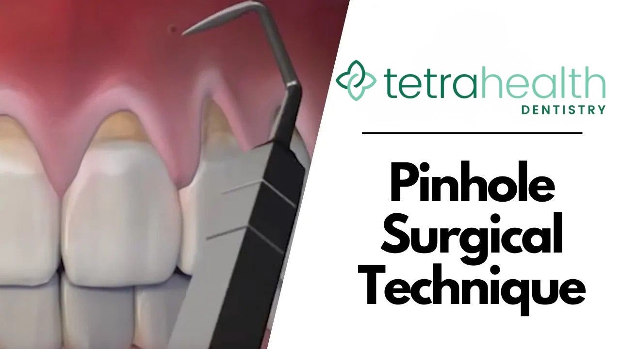 Pinhole Surgical Technique - Manhattan, NY - Dr. Alexander Volchonok