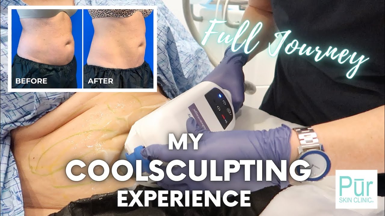My COOLSCULPTING EXPERIENCE | Full Journey + COOLSCULPTING BEFORE AND AFTER Photos | Pūr Skin Clinic