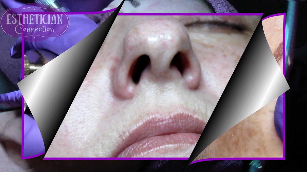 DermaMed HydraBright/MegaPeel Microderm Facial on the Esthetician Connection