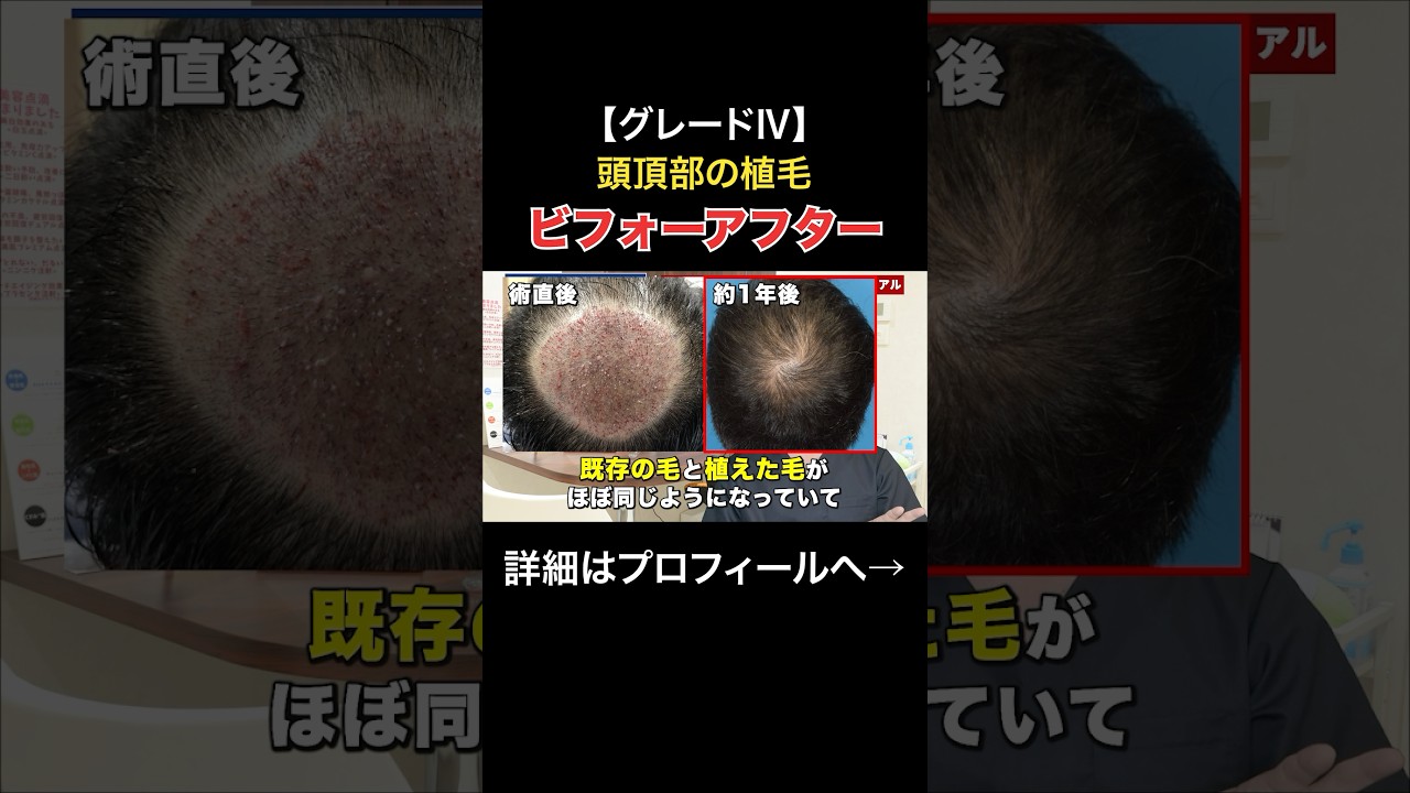 【症例紹介】30代グレードⅣ後頭部植毛10ヶ月後のリアル #shorts #aga #植毛 #薄毛治療