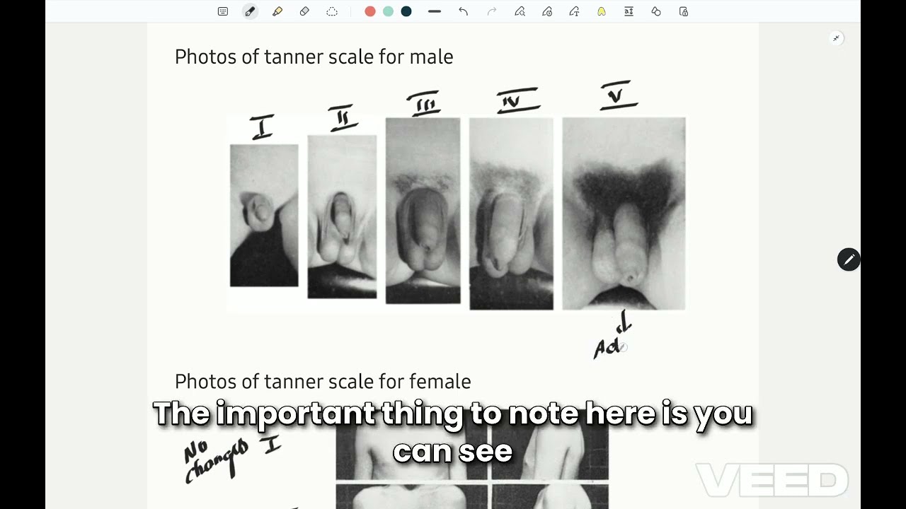 Tanner stages of development of puberty under 4 min #mbbs #pediatrics #education #neetpreparation
