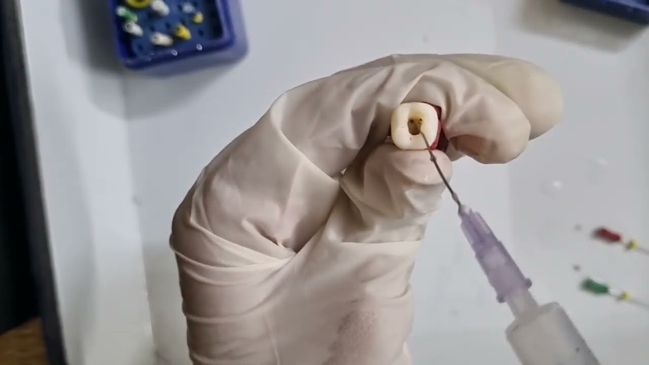 BMP - Cleaning & shaping using Stepback Technique in Second Molar