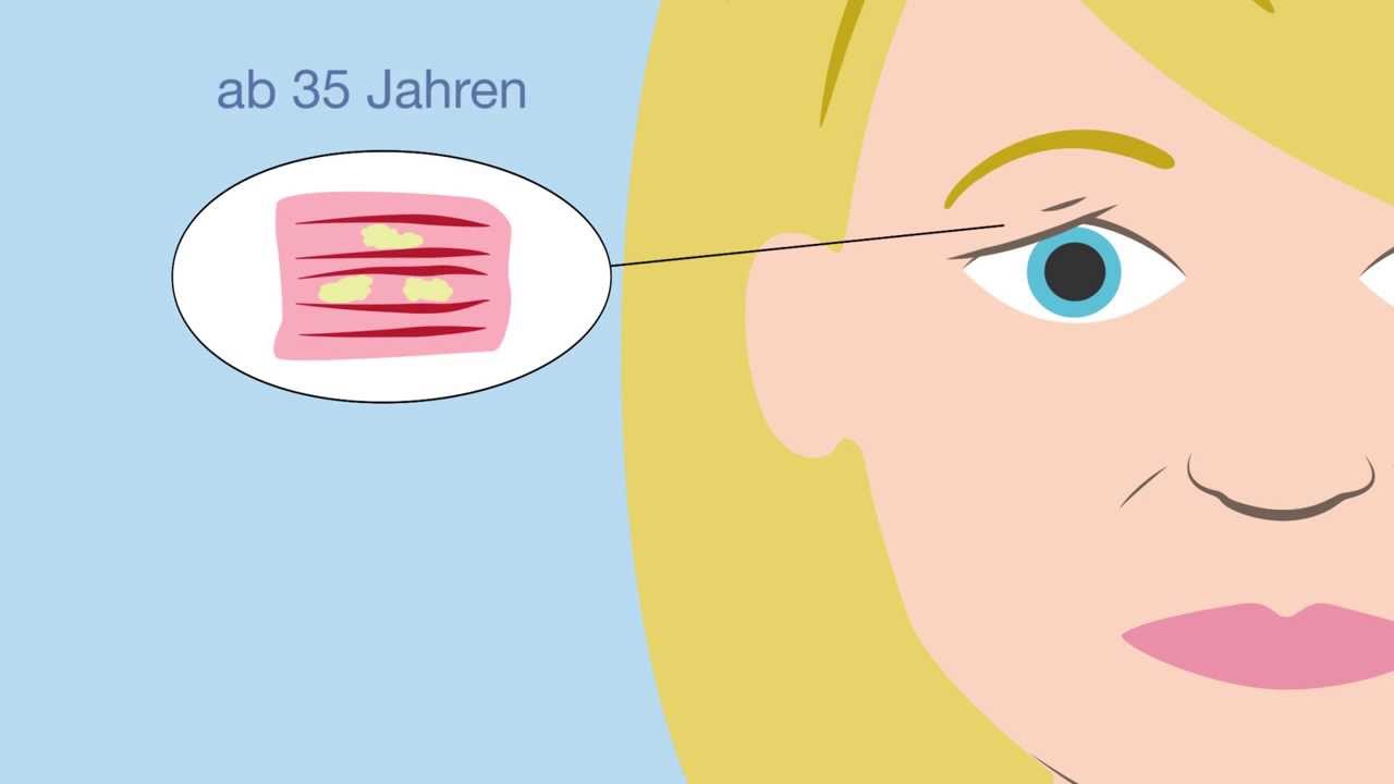 Lidstraffung einfach erkl&auml;rt! | Video by VerVieVas