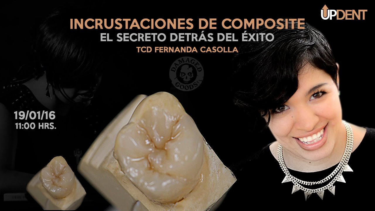 Incrustaciones de Composite. El secreto detrás del éxito.