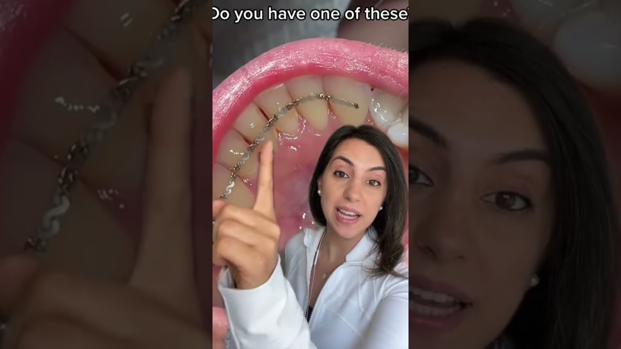 Retainers after braces! #dentist #braces #retainers #nicesmile #smilemakeover