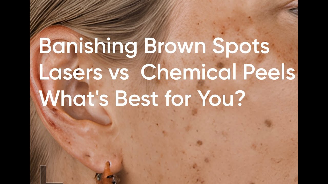 Banishing Brown Spots - Lasers vs  Chemical Peels What's Best for You?